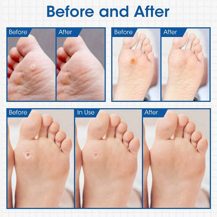Corn Pads for Toes 24pcs Gentle Callus Removal Toes and Feet Adhesive