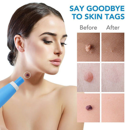 Auto Micro Skin Tag Remover Device Kit Safe Painless Removal 2-8 mm Band Tool